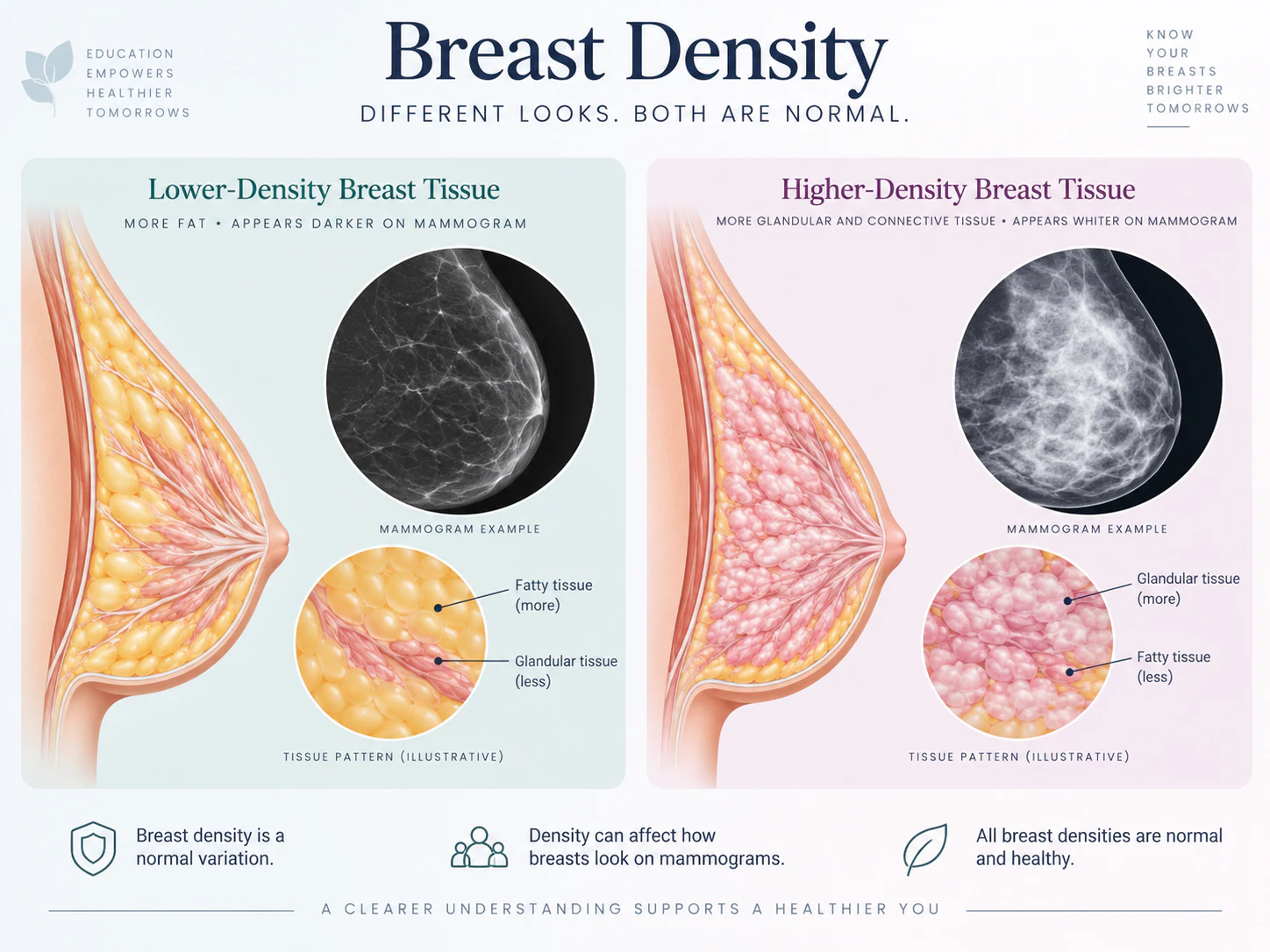 Breast density on breast imaging