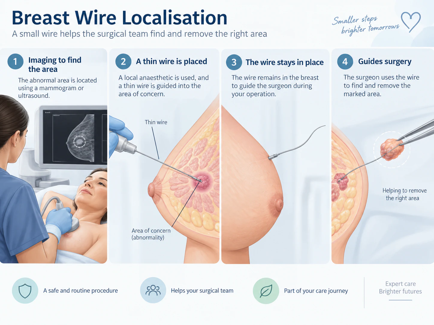 Breast wire localisation before surgery